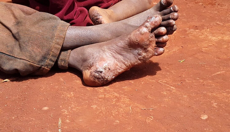 an individual infested with jiggers