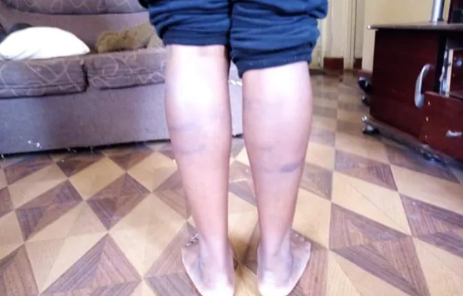 Tumu Tumu High School Girl Shows Off Bruises. 1