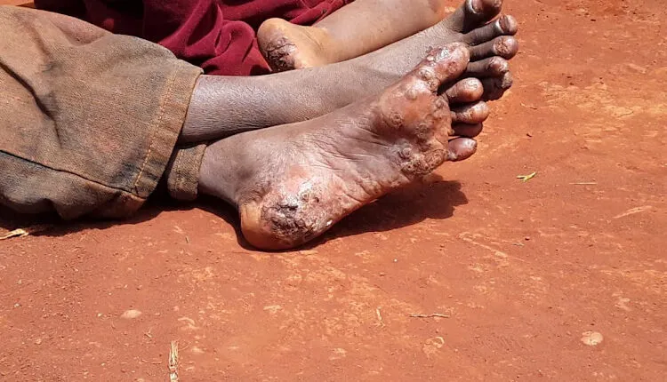 an individual infested with jiggers